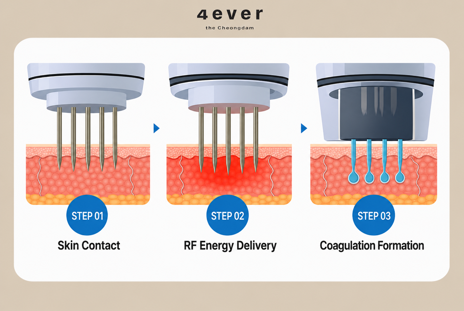 Skin Booster Delivery: Potenza Pumping Tip vs MTS vs LDM